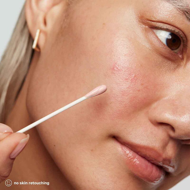 kate somerville eradikate acne treatment