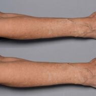 faces cold plasma skin strengthening therapy