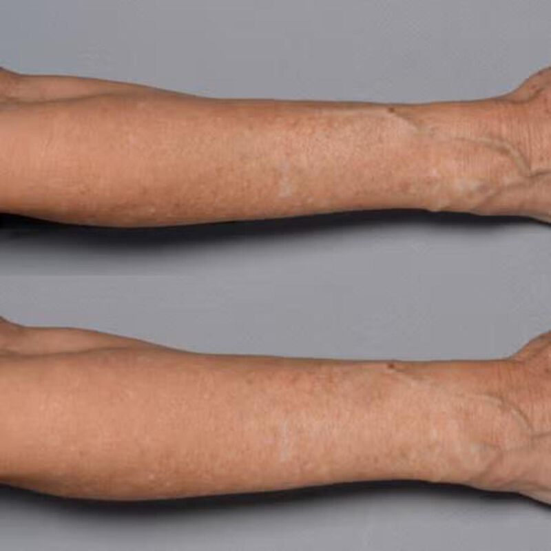 perricone md cold plasma skin strengthening therapy