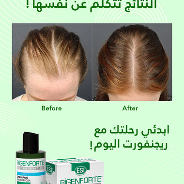 faces zero hair fall set