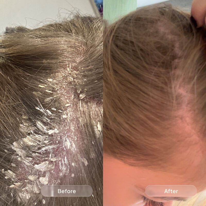 بلو سكين كير مجموعة روتين مكافحة القشرة والتهدئة